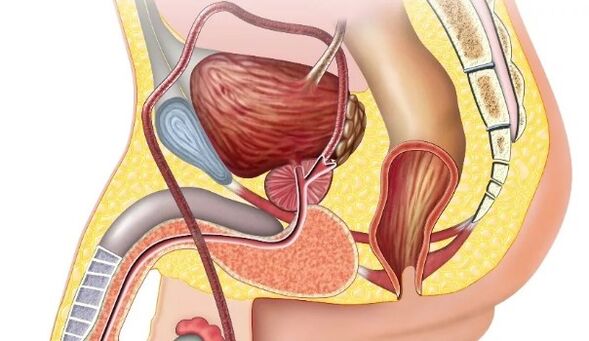 Chronesch Prostatitis