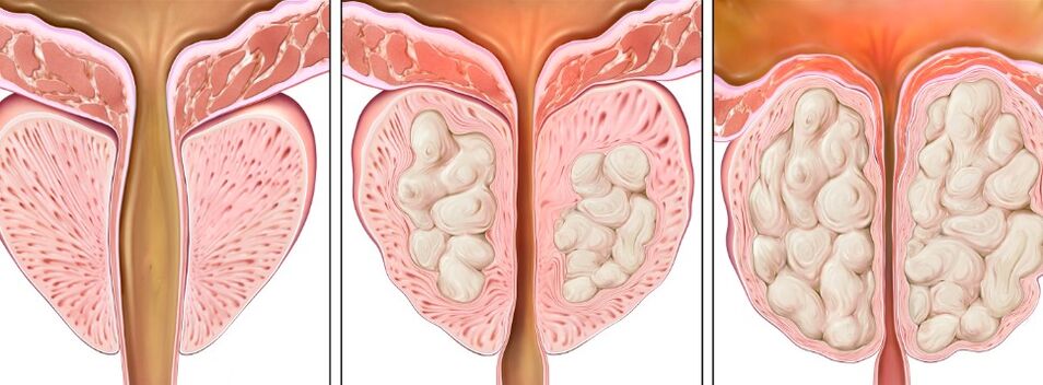 Stänn vun der Prostatitis