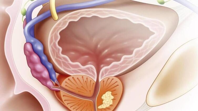 Chronesch Prostatitis